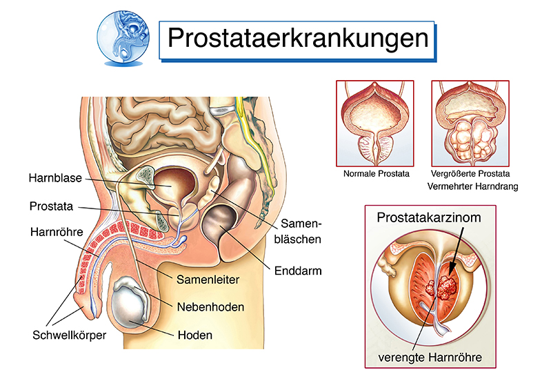 Prostataerkrankung